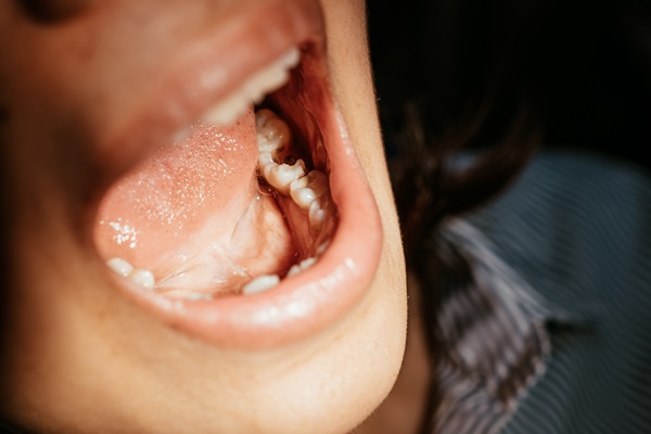 Signs Of A Worn Dental Filling